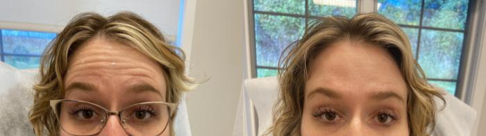 Before & After Injectables- Savannah, RN Case 347 Frontalis View in Barrington, Illinois