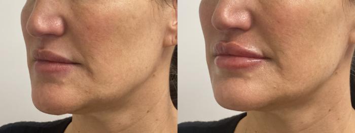 Before & After Injectables- Tracy, RN Case 342 Left Oblique View in Barrington, Illinois