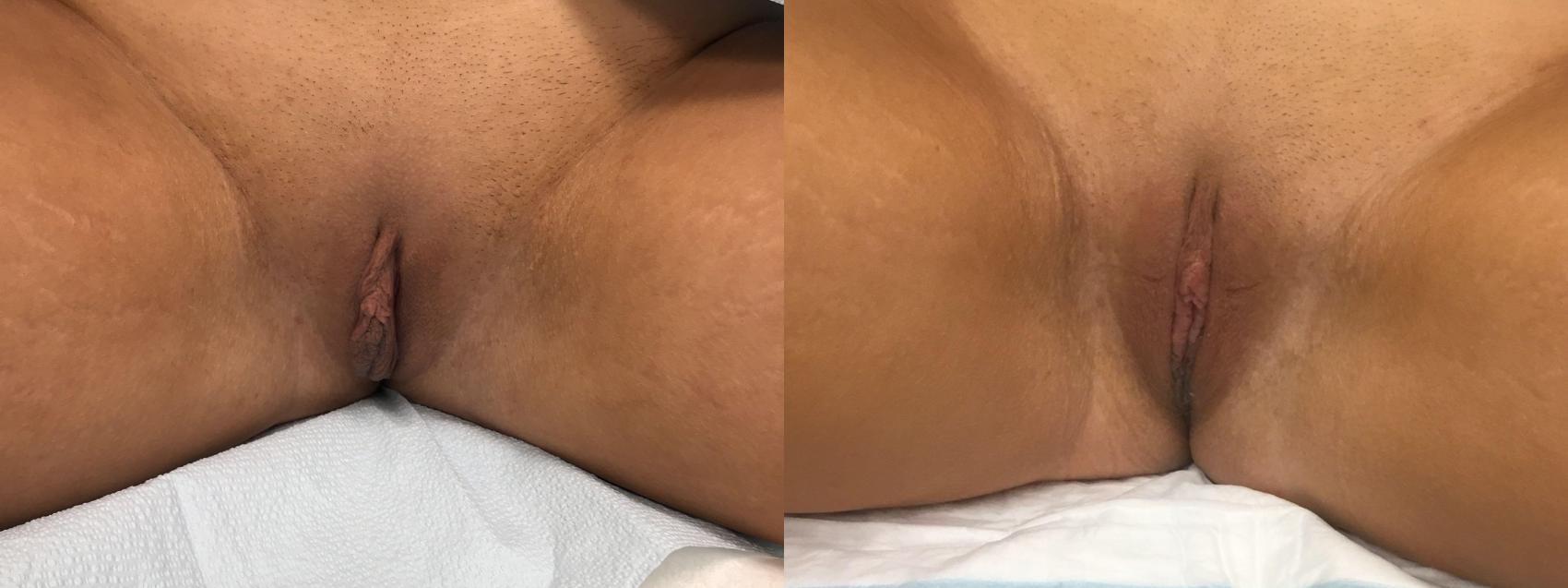 Before & After Labiaplasty Case 137 Front View in Barrington, Illinois