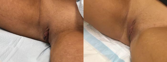 Before & After Labiaplasty Case 137 Left Oblique View in Barrington, Illinois