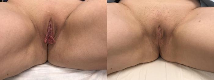 Before & After Labiaplasty Case 138 Front View in Barrington, Illinois