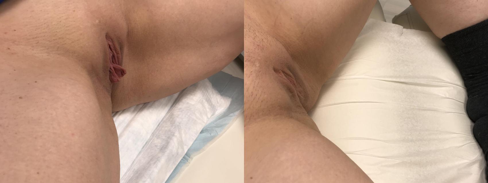 Before & After Labiaplasty Case 138 Right Side View in Barrington, Illinois