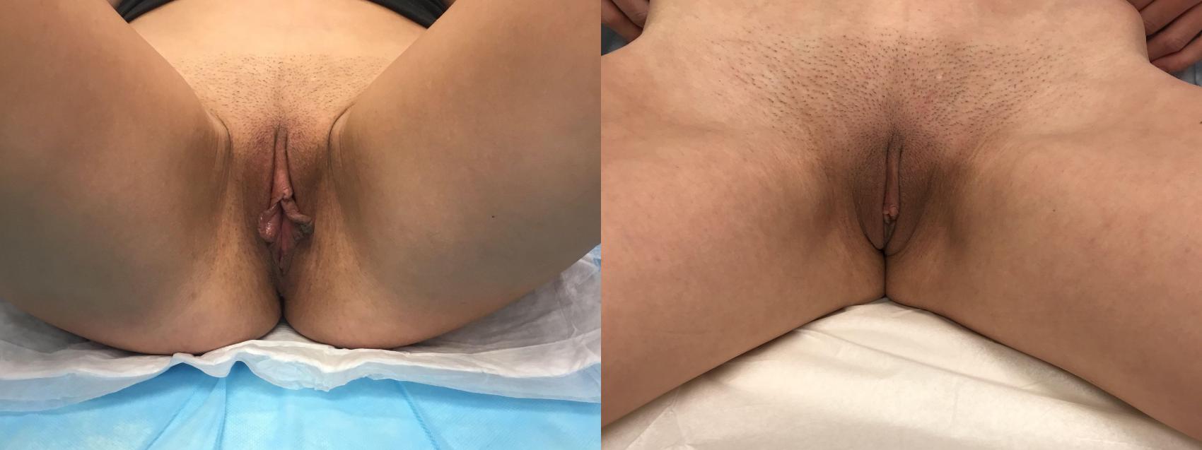 Before & After Labiaplasty Case 139 Front View in Barrington, Illinois