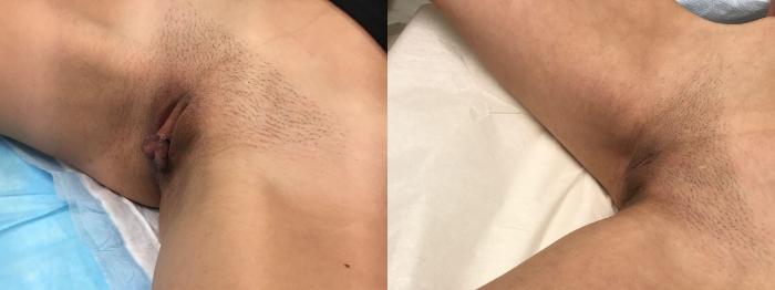 Before & After Labiaplasty Case 139 Left Side View in Barrington, Illinois