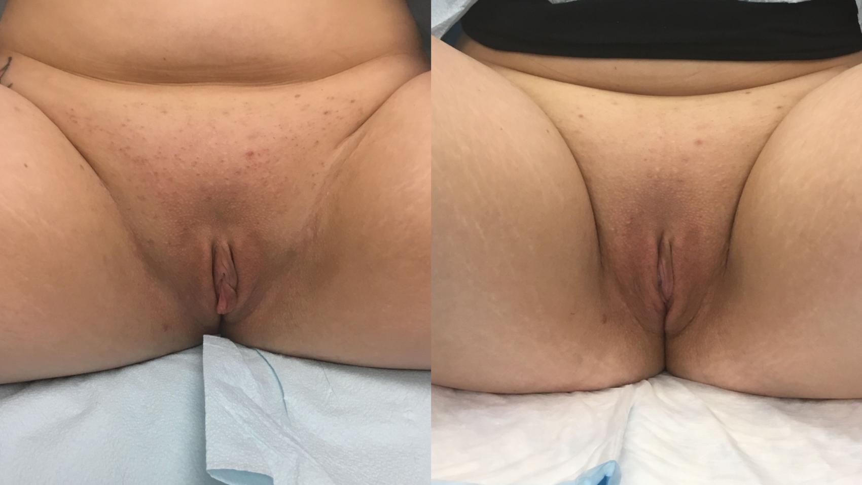 Before & After Labiaplasty Case 159 Front View in Barrington, Illinois