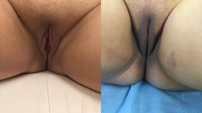 Before & After Labiaplasty Case 204 Front View in Barrington, Illinois