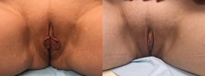 Before & After Labiaplasty Case 219 Front View in Barrington, Illinois