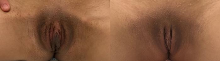 Before & After Labiaplasty Case 248 Front View in Barrington, Illinois
