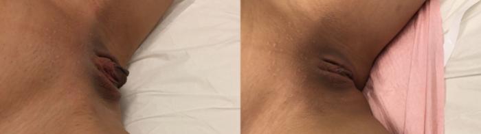 Before & After Labiaplasty Case 248 Right Side View in Barrington, Illinois