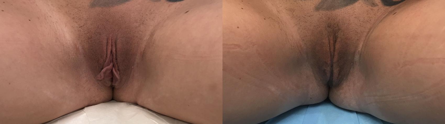 Before & After Labiaplasty Case 254 Front View in Barrington, Illinois