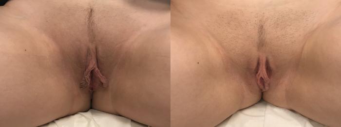 Before & After Labiaplasty Case 326 Front View in Barrington, Illinois