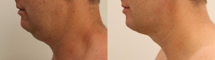 Before & After Liposuction Case 124 Left Side View in Barrington, Illinois