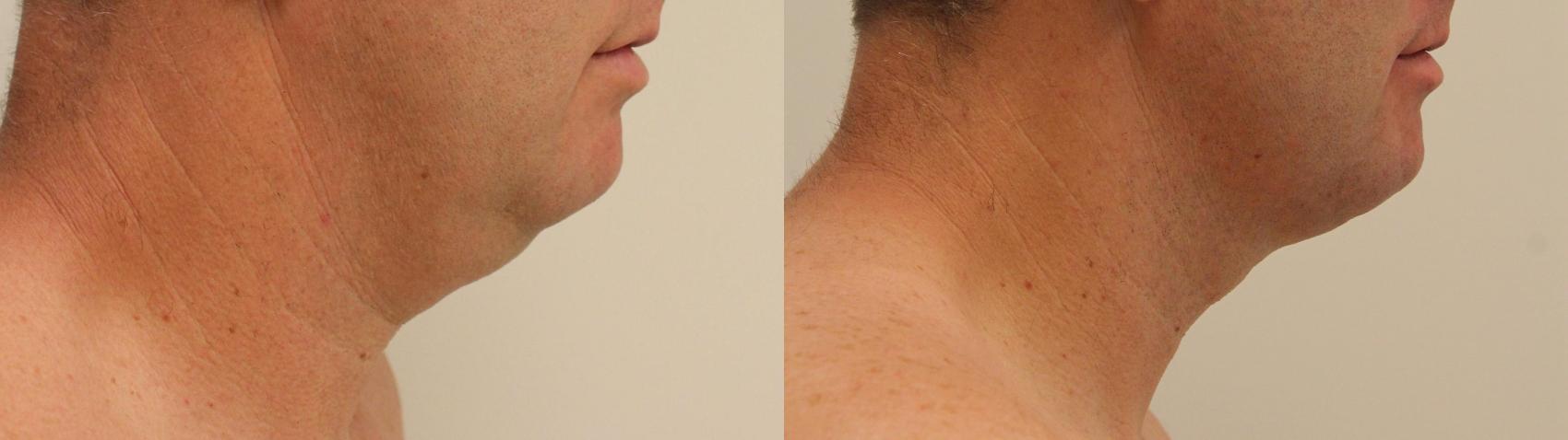 Before & After Liposuction Case 124 Right Side View in Barrington, Illinois
