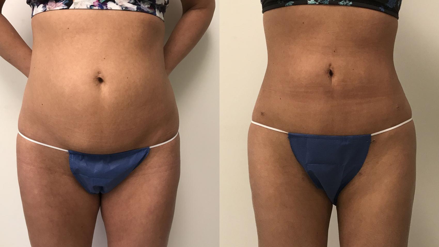 Before & After Liposuction Case 142 Front View in Barrington, Illinois