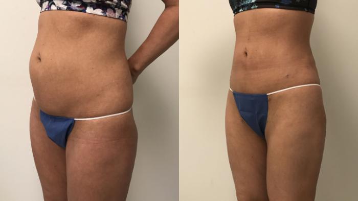 Before & After Liposuction Case 142 Left Oblique View in Barrington, Illinois