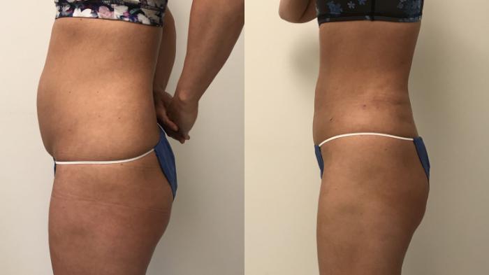 Before & After Liposuction Case 142 Left Side View in Barrington, Illinois