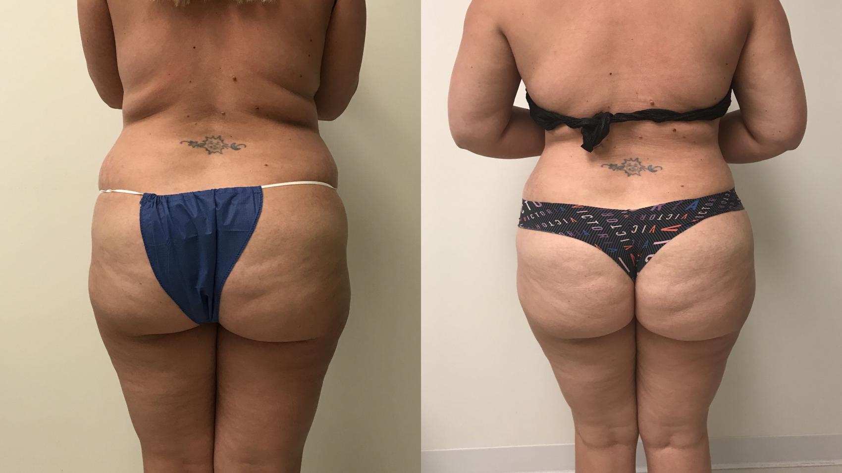 Before & After Liposuction Case 148 Back View in Barrington, Illinois