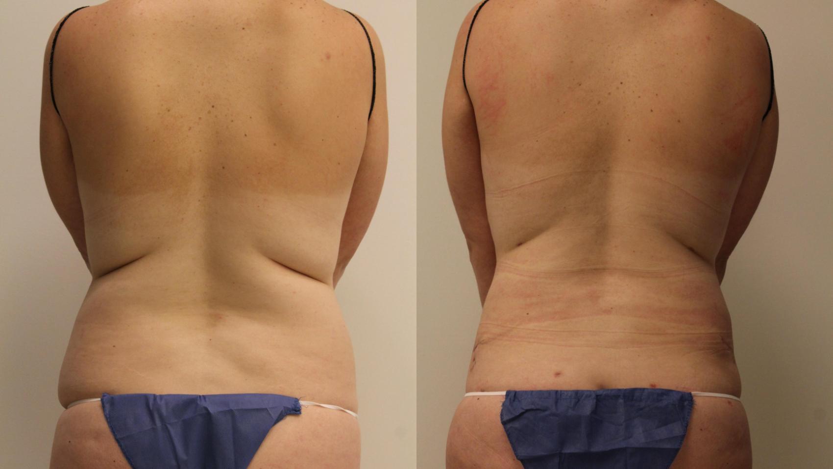 Before & After Liposuction Case 150 Back View in Barrington, Illinois