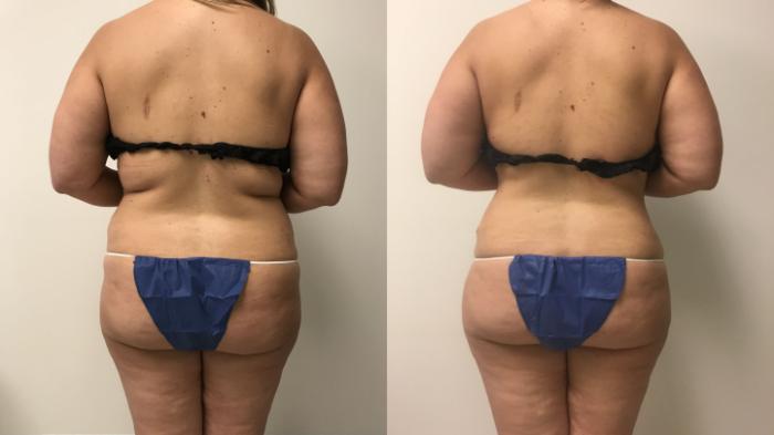 Before & After Liposuction Case 162 Back View in Barrington, Illinois