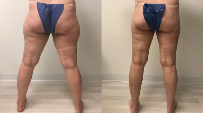 Before & After Liposuction Case 164 Back View in Barrington, Illinois
