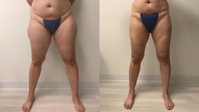 Before & After Liposuction Case 164 Front View in Barrington, Illinois