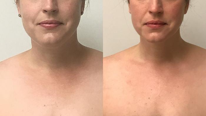 Before & After Liposuction Case 165 Front View in Barrington, Illinois