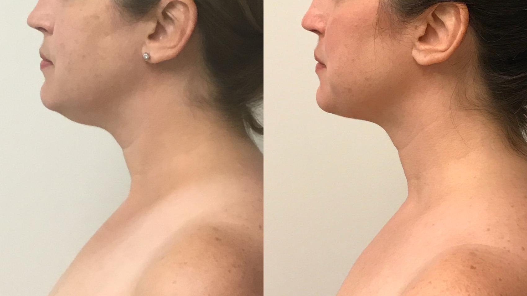 Before & After Liposuction Case 165 Left Side View in Barrington, Illinois