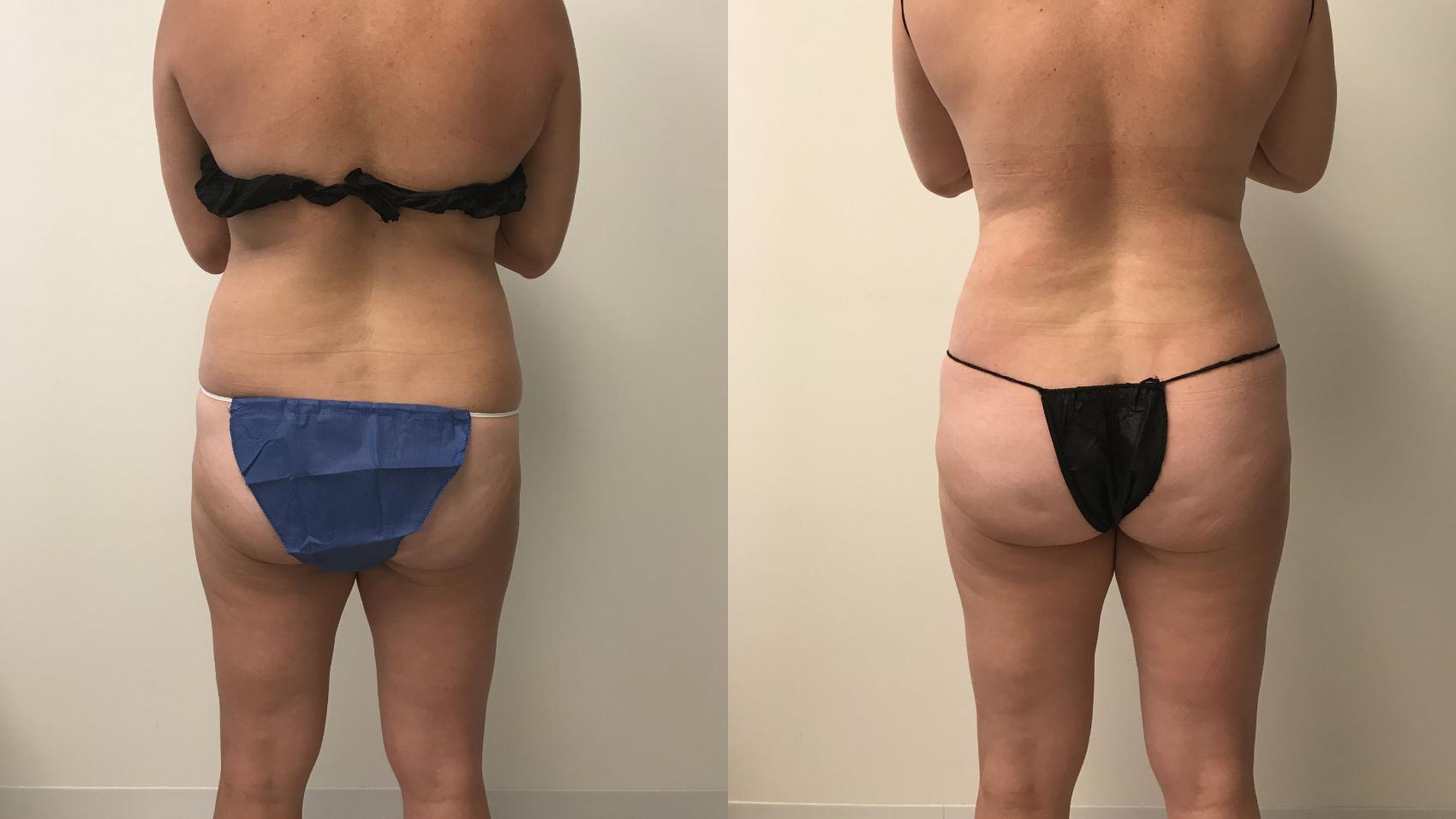 Before & After Liposuction Case 186 Back View in Barrington, Illinois