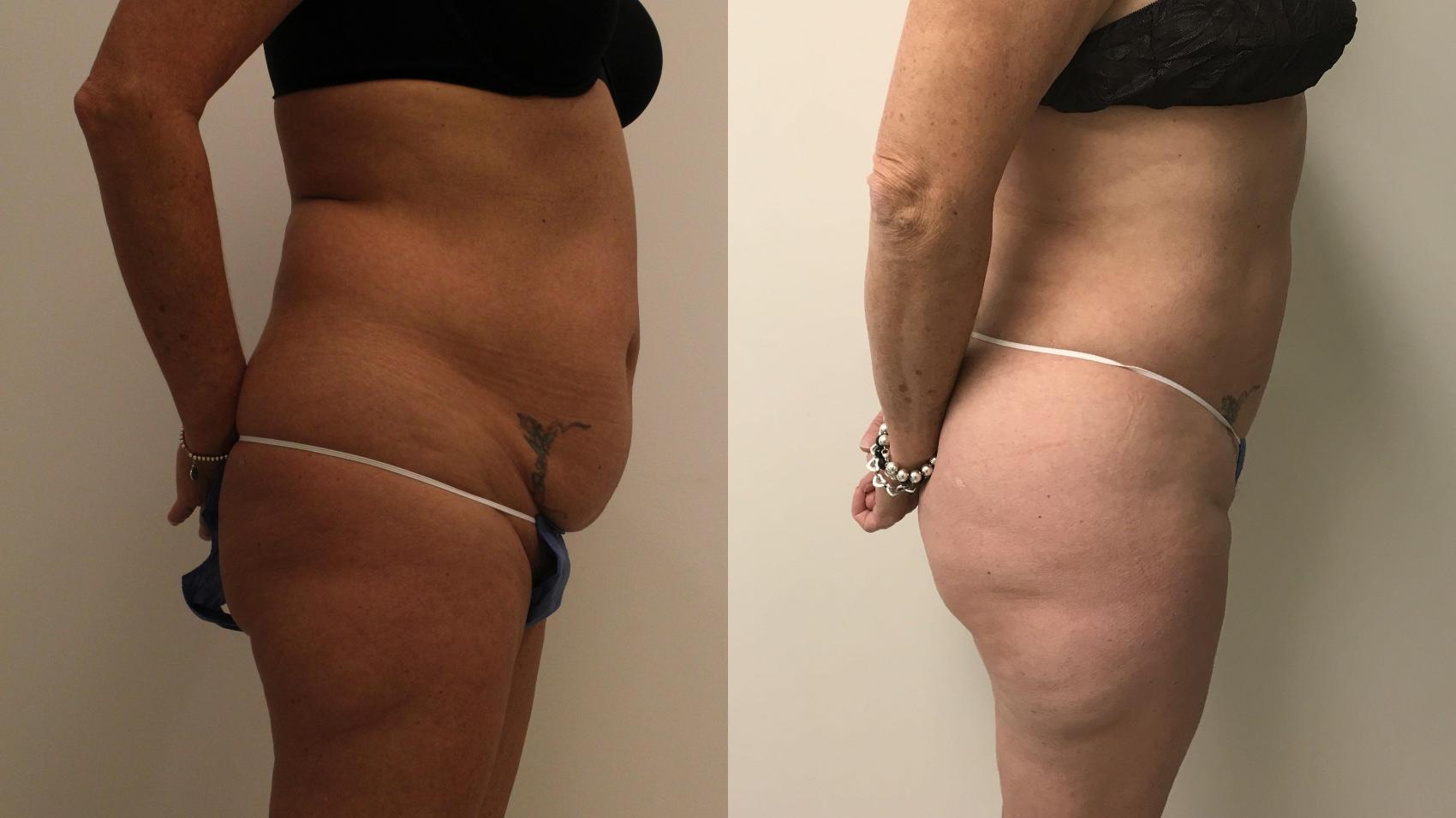 Before & After Liposuction Case 187 Front View in Barrington, Illinois