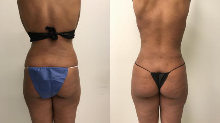 Before & After Liposuction Case 215 Back View in Barrington, Illinois