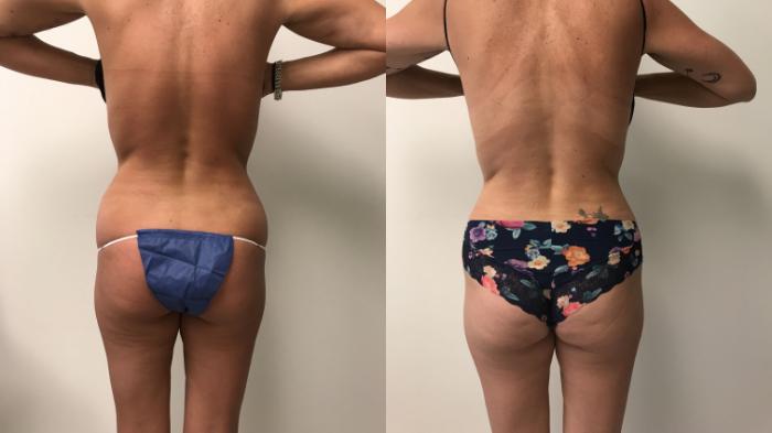 Before & After Liposuction Case 228 Back View in Barrington, Illinois