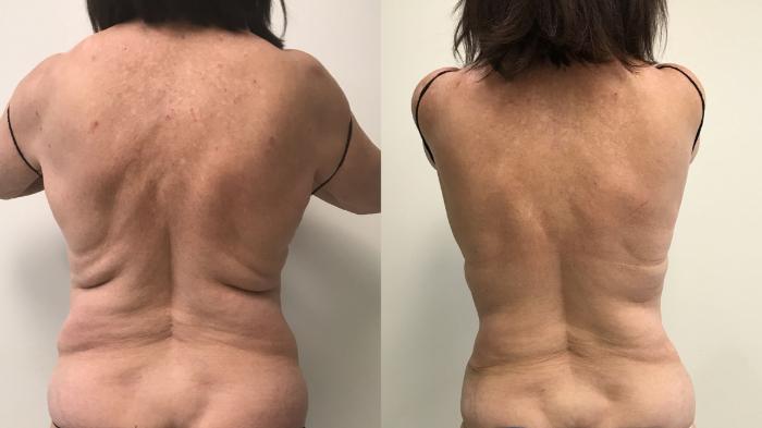 Before & After Liposuction Case 244 Back View in Barrington, Illinois