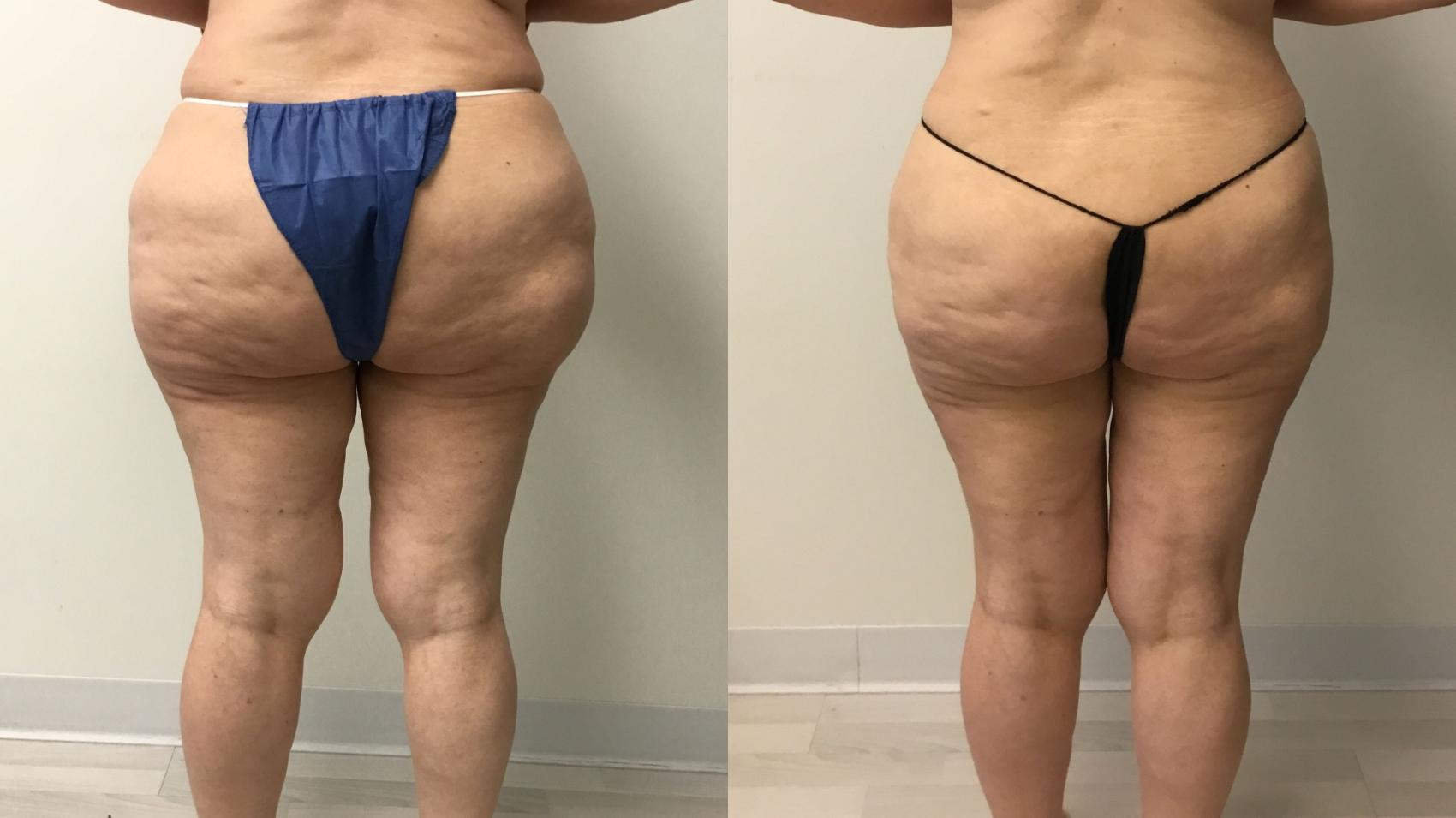 Before & After Liposuction Case 253 Back View in Barrington, Illinois