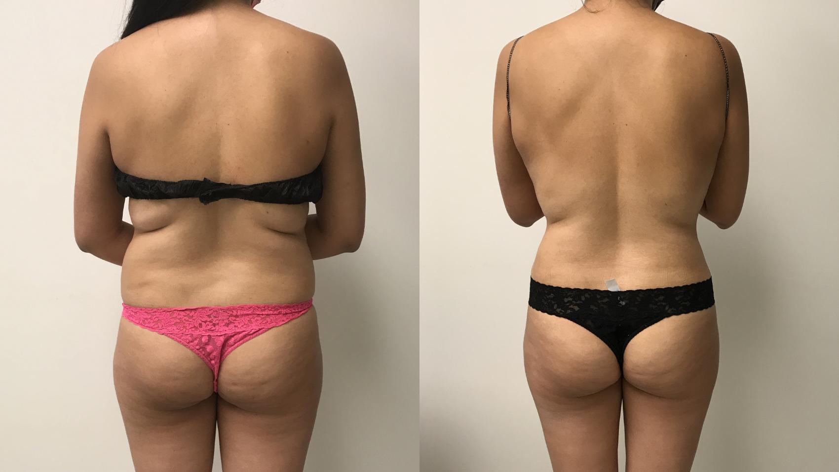Before & After Liposuction Case 263 Back View in Barrington, Illinois