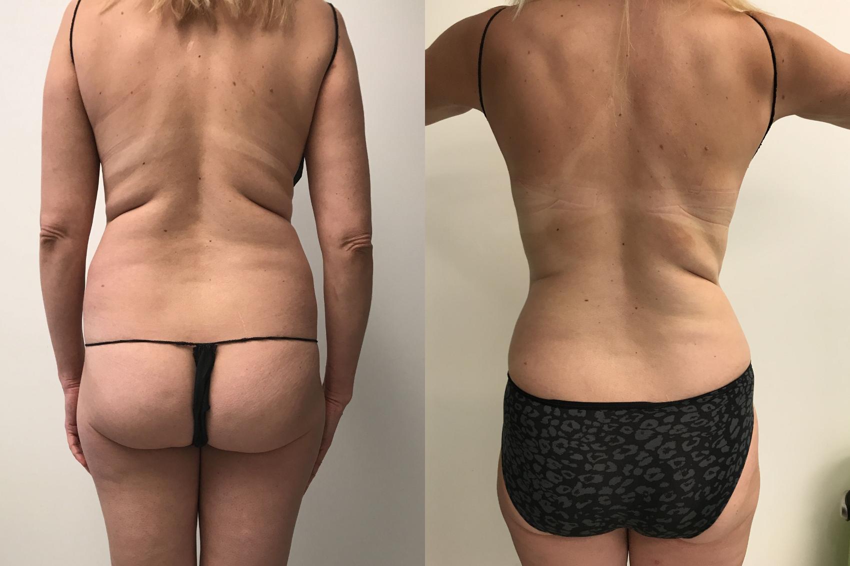 Before & After Liposuction Case 268 Front View in Barrington, Illinois