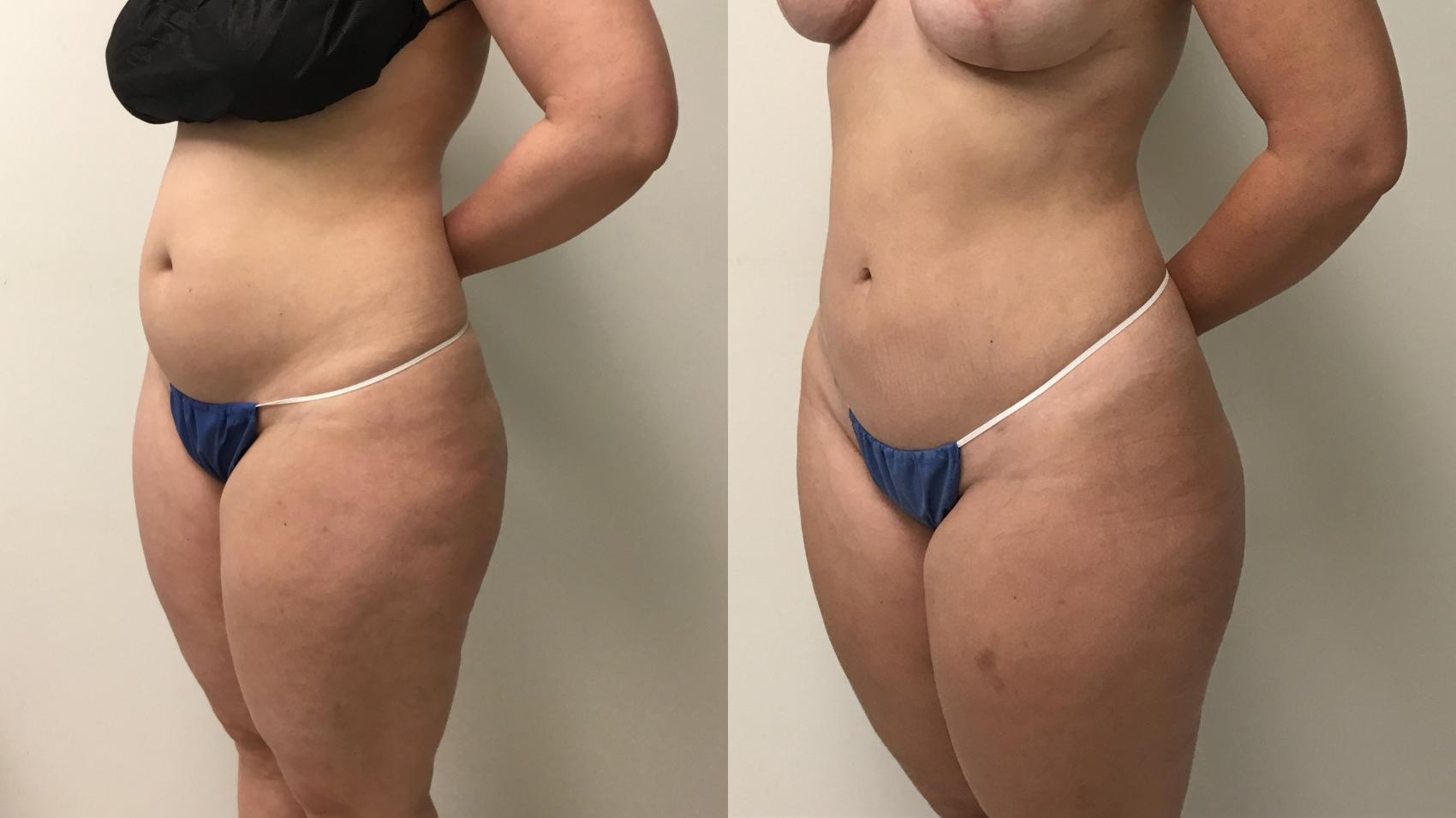 Before & After Liposuction Case 274 Left Oblique View in Barrington, Illinois