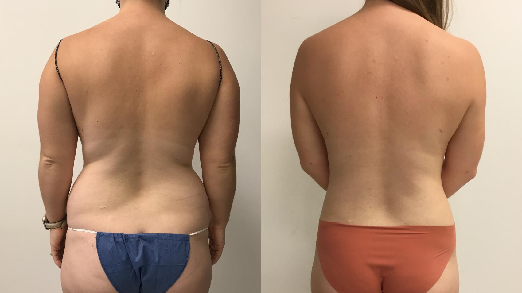 Before & After Liposuction Case 284 Back View in Barrington, Illinois