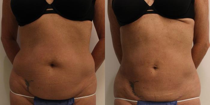 Before & After Liposuction Case 52 View #1 View in Barrington, Illinois
