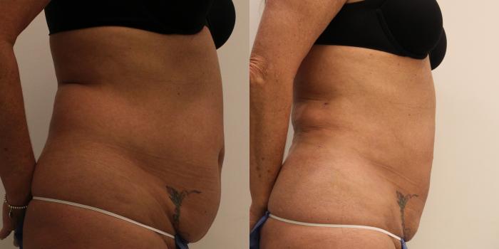 Before & After Liposuction Case 52 View #2 View in Barrington, Illinois