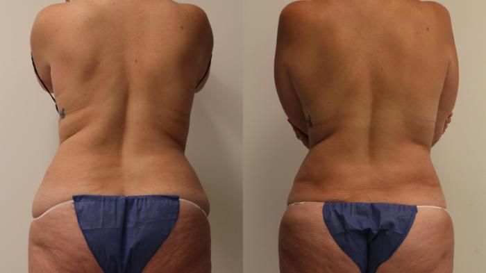 Before & After Liposuction Case 72 Back View in Barrington, Illinois