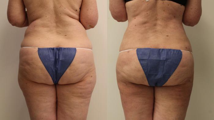 Before & After Liposuction Case 94 Back View in Barrington, Illinois