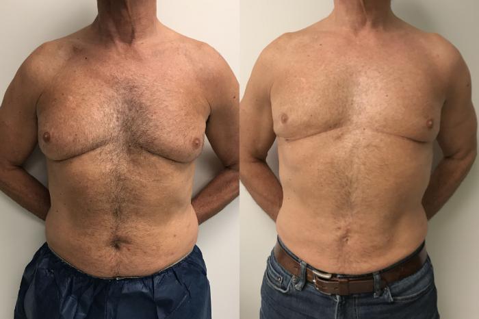 Before & After Male Gynecomastia Case 312 Front View in Barrington, Illinois
