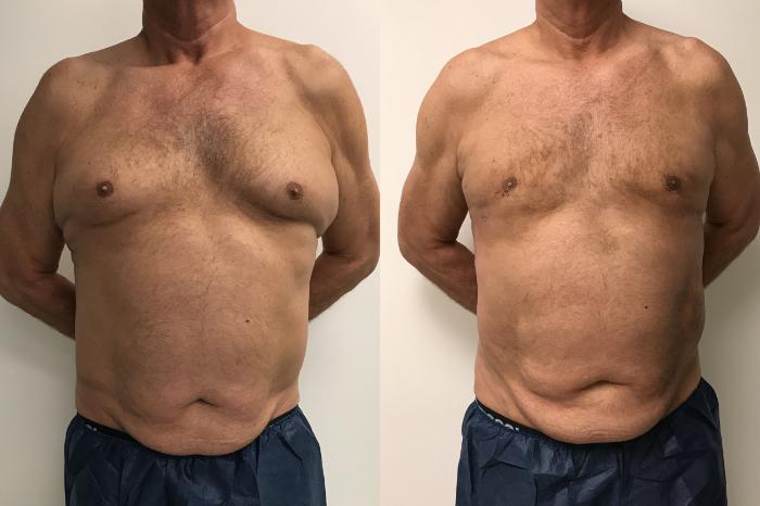 Before & After Male Gynecomastia Case 314 Front View in Barrington, Illinois