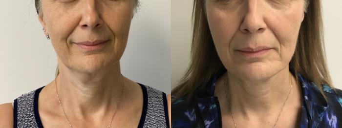 Before & After MyEllevate®/ MyEllevate® Plus Case 292 Front View in Barrington, Illinois