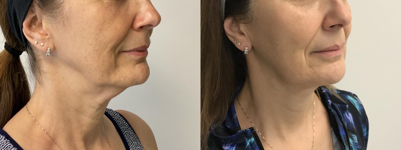 Before & After MyEllevate®/ MyEllevate® Plus Case 292 Right Oblique View in Barrington, Illinois