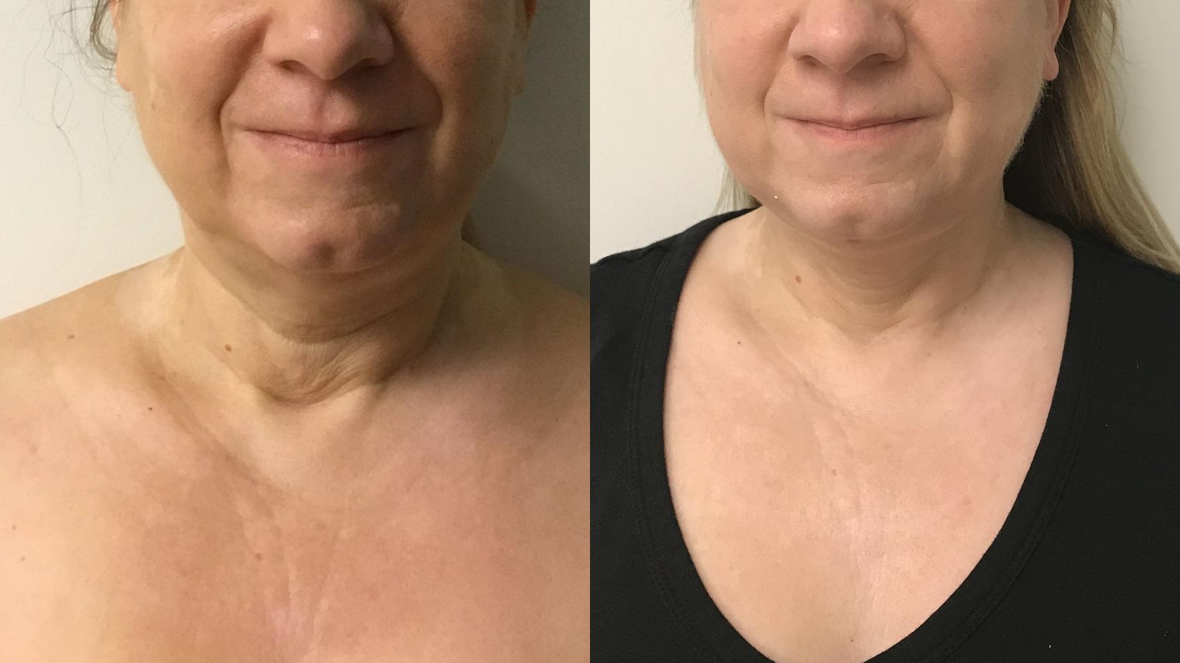 Before & After MyEllevate®/ MyEllevate® Plus Case 293 Front View in Barrington, Illinois