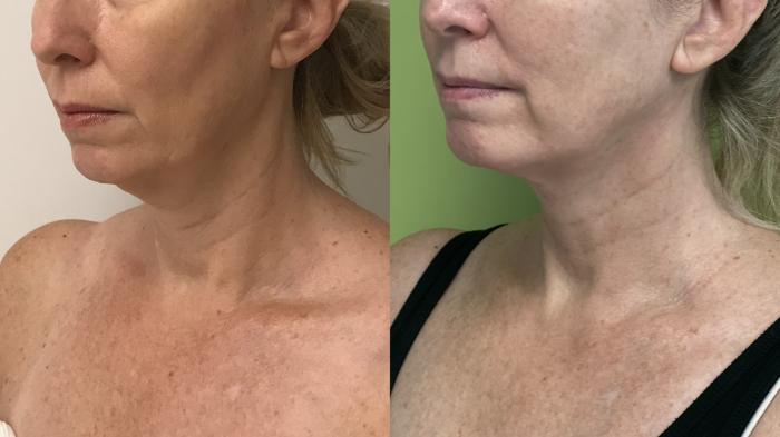 Before & After MyEllevate®/ MyEllevate® Plus Case 296 Left Oblique View in Barrington, Illinois