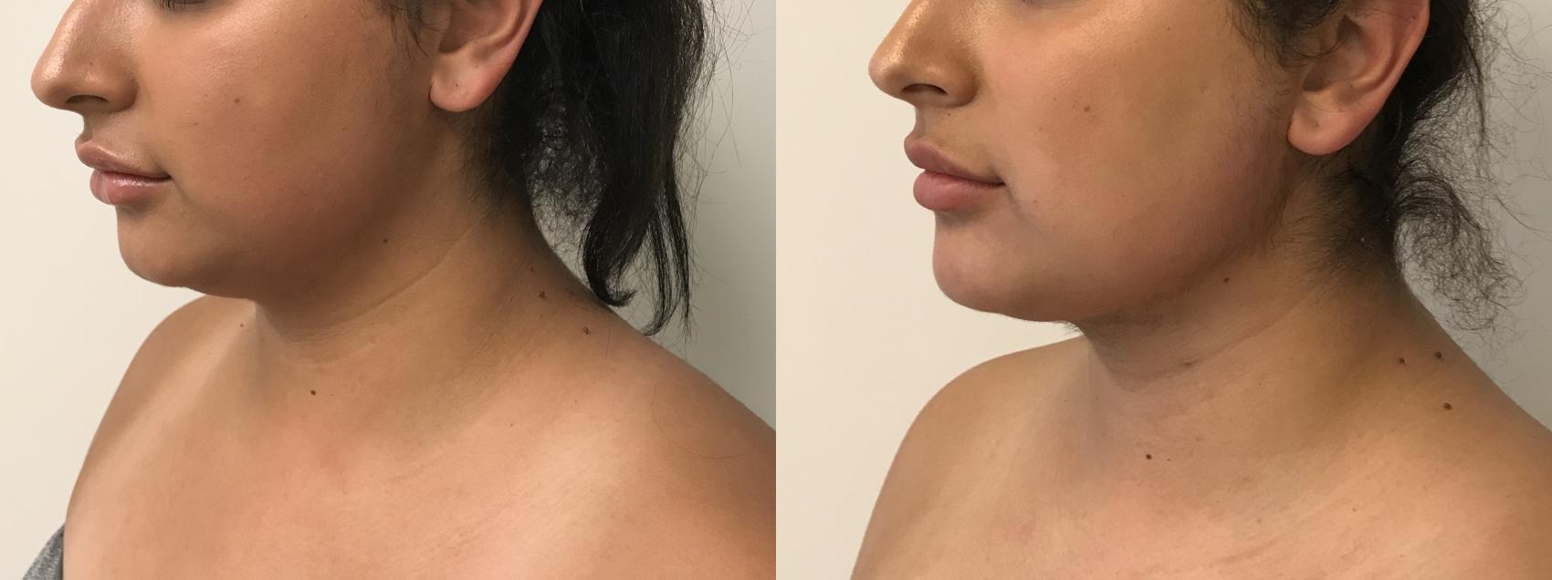 Before & After MyEllevate®/ MyEllevate® Plus Case 298 Left Side View in Barrington, Illinois