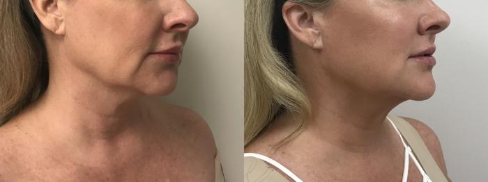 Before & After MyEllevate®/ MyEllevate® Plus Case 325 Right Side View in Barrington, Illinois