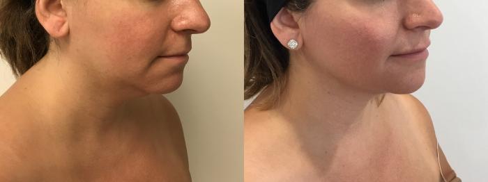 Before & After MyEllevate®/ MyEllevate® Plus Case 340 Right Oblique View in Barrington, Illinois